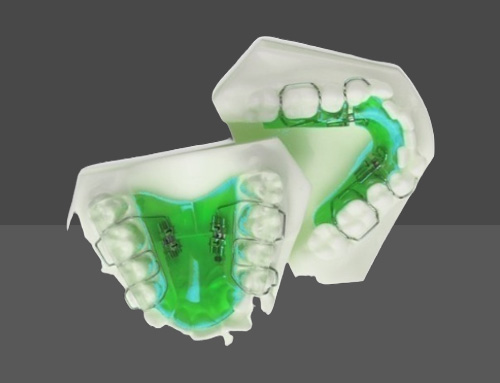 Expansion plate without srew